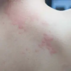 Éruption cutanée rouge sur le dos, possiblement due à une allergie cigarette électronique.