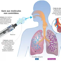 Le vapotage peut causer des douleurs thoraciques dues à l'inhalation de substances nocives et à l'obstruction des alvéoles pulmonaires.
