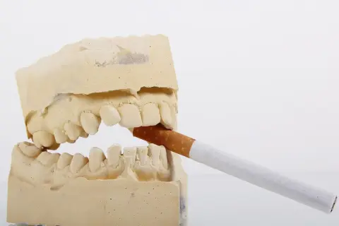 Modèle dentaire avec une cigarette. Le vapotage sans nicotine et les dents, une image qui fait réfléchir.