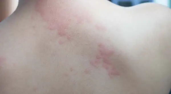 Éruption cutanée rouge sur le dos, possiblement due à une allergie cigarette électronique.