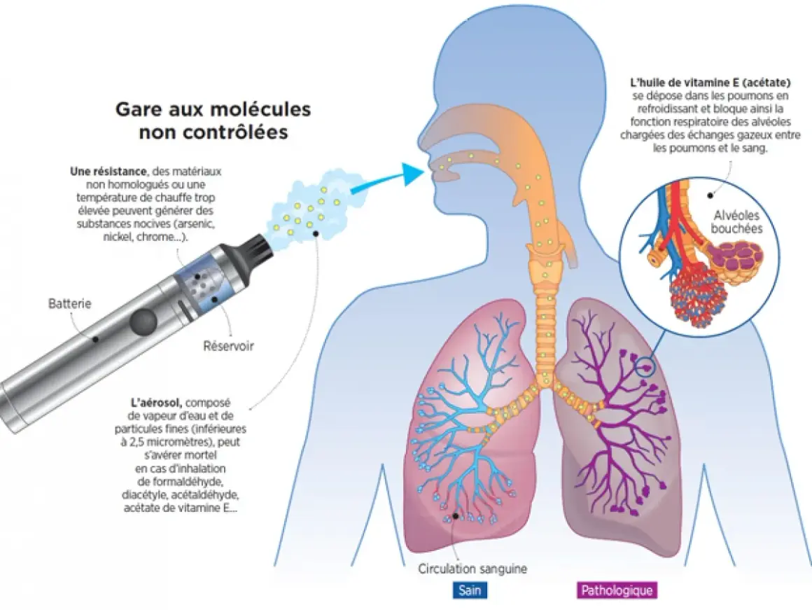 Le vapotage peut causer des douleurs thoraciques dues à l'inhalation de substances nocives et à l'obstruction des alvéoles pulmonaires.