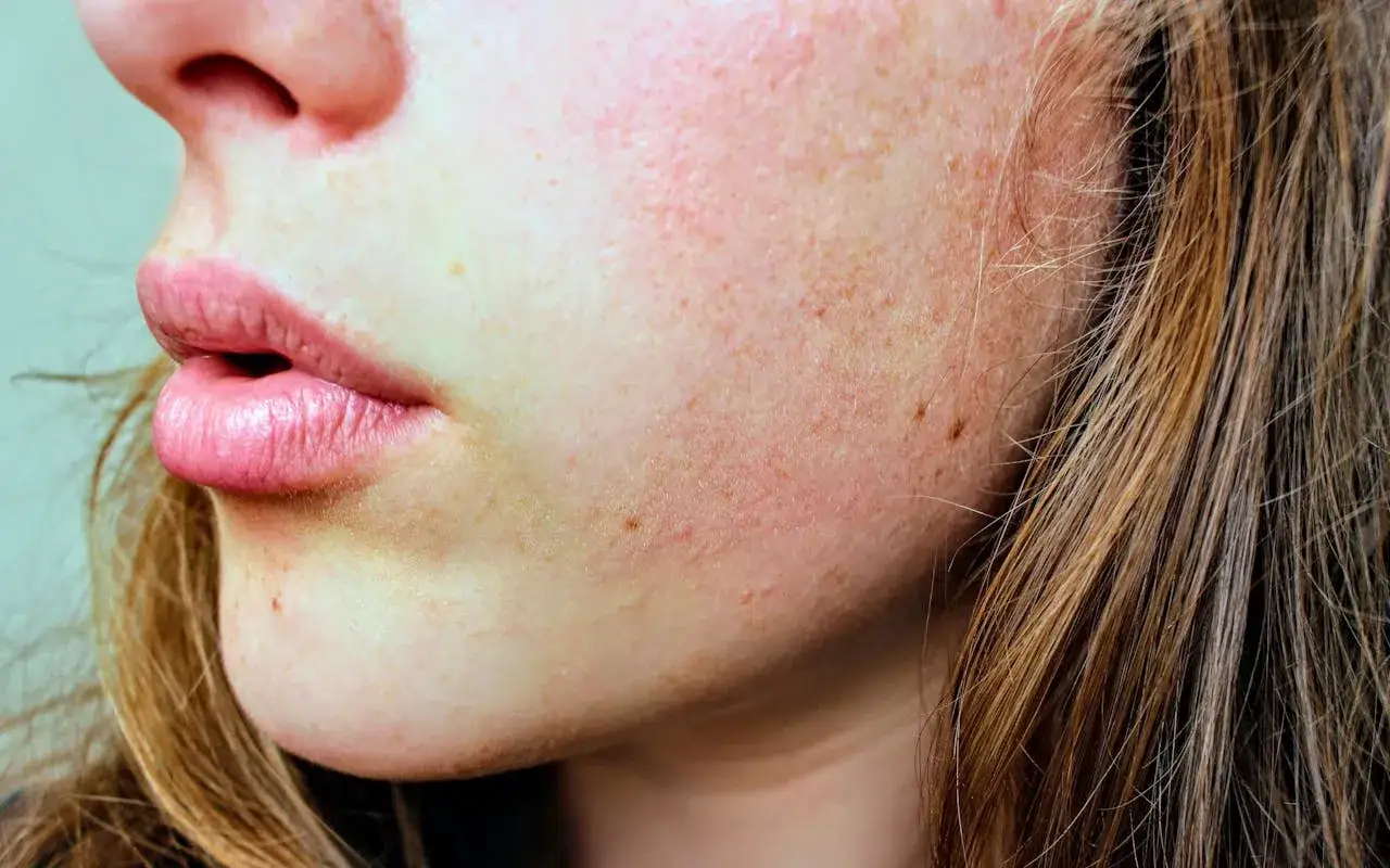Gros plan sur la peau du visage d'une jeune femme, avec des taches de rousseur et des rougeurs. On aper&ccedil;oit ses l&egrave;vres roses et une m&egrave;che de cheveux ch&acirc;tain. L'image &eacute;voque l'usage de la cigarette &eacute;lectronique.