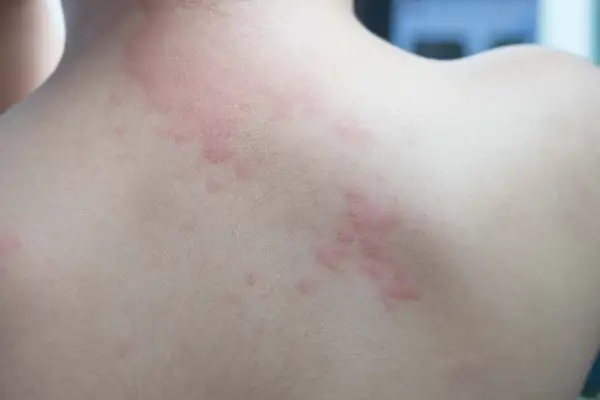 Éruption cutanée rouge sur le dos, possiblement due à une allergie cigarette électronique.